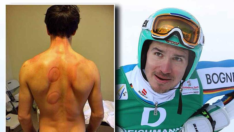 Felix Neureuther postet ein Foto: "Die Behandlungen zeigen ihre Wirkung!" Felix Neureuther postet ein Foto: "Die Behandlungen zeigen ihre Wirkung!"