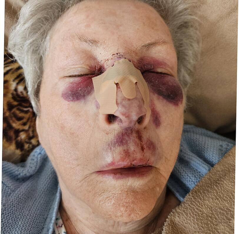 Hannelore O. nach ihrem schweren Sturz im Krankenhaus.