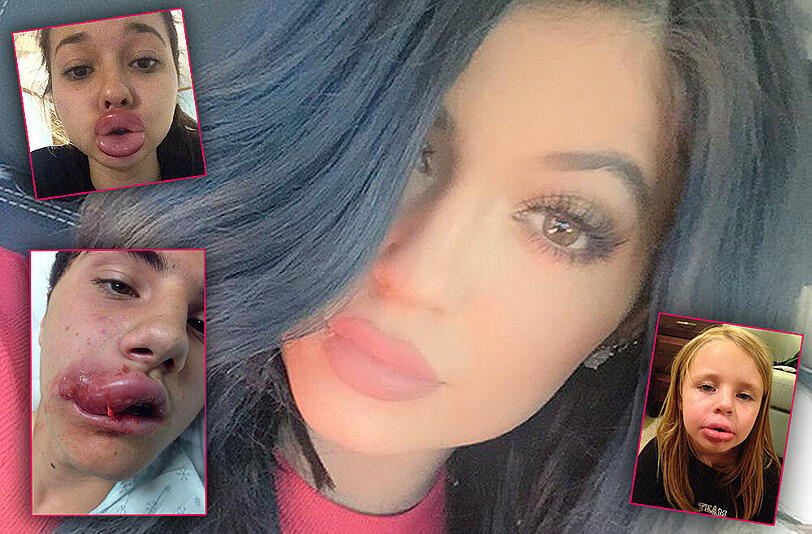 Die Fans von Kylie Jenner riskieren für einen ähnlichen Schmollmund nicht nur eine dicke Lippe - sondern vor allem ihre Gesundheit.