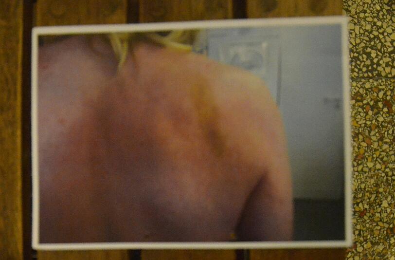 Die Fotos sind nach dem Polizeiübergriff in der Arztpraxis gemacht worden: Deutlich zu sehen: blaue Flecken am Rücken und...