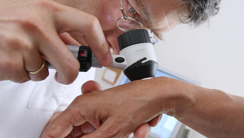 Ein Hautarzt untersucht in seiner Praxis mit einem Vergrößerungsglas die Haut einer Patientin bei einer Hautkrebs-Früherkennung. Ab 35 Jahren übernehmen die Krankenkassen die Kosten für eine regelmäßige Untersuchung. Ein Hautarzt untersucht in seiner Praxis mit einem Vergrößerungsglas die Haut einer Patientin bei einer Hautkrebs-Früherkennung. Ab 35 Jahren übernehmen die Krankenkassen die Kosten für eine regelmäßige Untersuchung.