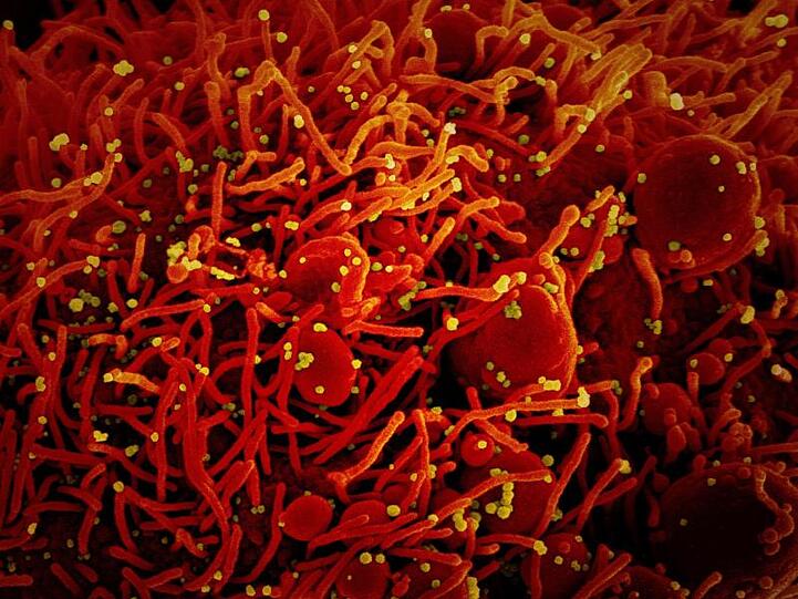 Aufnahme eine Zelle (rot), die mit dem Coronavirus (SARS-CoV-2, gelb) infiziert ist.