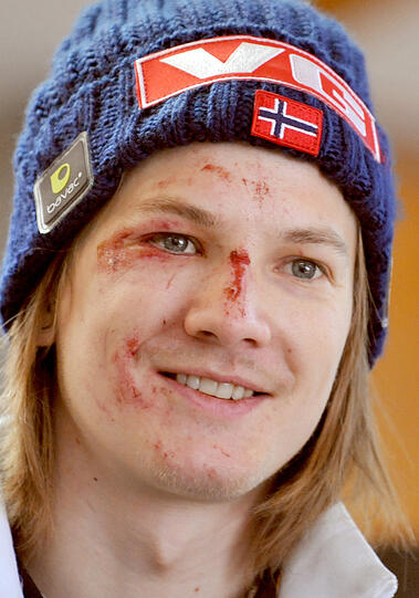 Die Spuren des Horror-Sturzes sind ins Gesicht von Tom Hilde gezeichnet. Doch der Norweger kann schon wieder lachen.