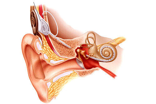 Der Sound-Prozessor hinter dem Ohr wandelt den Schall in digitale Signale um und schickt sie durch die Haut zum Implantat. Das macht daraus elektrische Impulse, die wiederum den Hörnerv stimulieren.