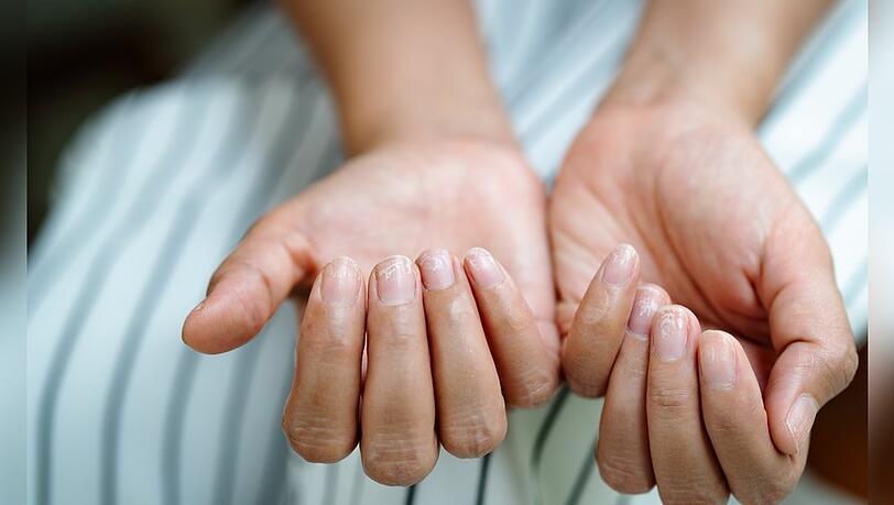 Brüchige Nägel haben meist einen Grund. Brüchige Nägel haben meist einen Grund.