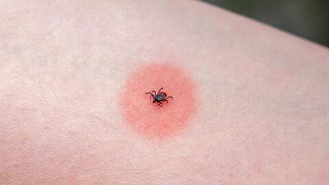 Die sogenannte Wanderr&ouml;te ist ein typisches Anzeichen einer Borreliose.