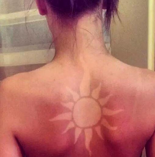 Der #sunburnart-Trend verbreitet sich auf Twitter rasend schnell. Hautärzte warnen vor den Gefahren.