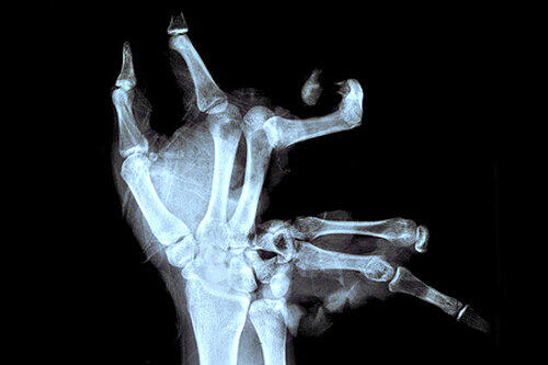 So sieht eine Hand im Röntgenbild aus, in der ein Feuerwerks-Kracher explodiert ist. Die Schäden sind oft irreparabel.