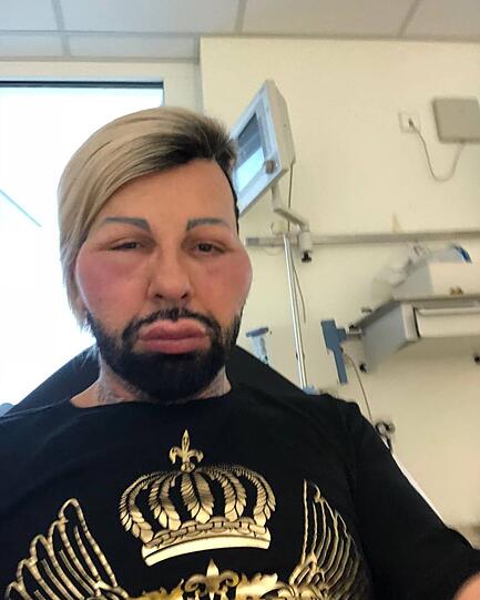 Allergische Reaktion: Harald Glööckler musste in eine Klinik.