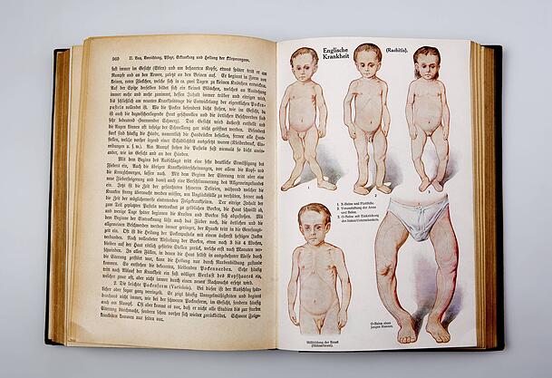 Vitamin-D-Mangel kann bei Kindern zu Rachitis und Fehlbildungen führen. Vitamin-D-Mangel kann bei Kindern zu Rachitis und Fehlbildungen führen.