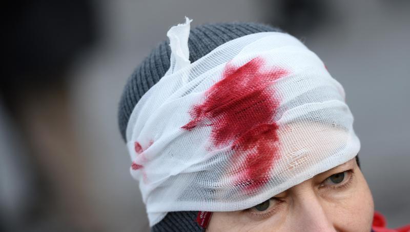 Eine Teilnehmerin einer Demonstration des "Aktionsbündnis gegen die NATO Sicherheitskonferenz" trägt einen Verband mit künstlichem Blut am Kopf. Foto: picture alliance / dpa/Archivbild Eine Teilnehmerin einer Demonstration des "Aktionsbündnis gegen die NATO Sicherheitskonferenz" trägt einen Verband mit künstlichem Blut am Kopf. Foto: picture alliance / dpa/Archivbild