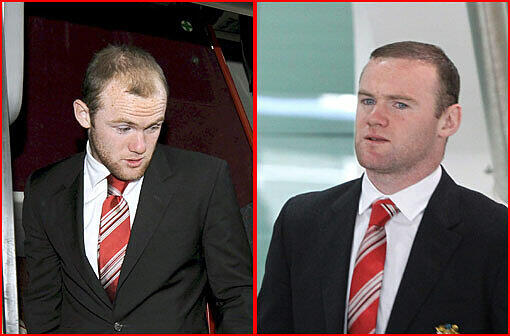Fußballstar Wayne Rooney trägt seit seiner Haartransplantation wieder einen vollen Schopf. Der Brite machte kein Geheimnis aus dem Eingriff. "Warum hätte ich es nicht tun sollen?", twitterte er im Juni 2011.