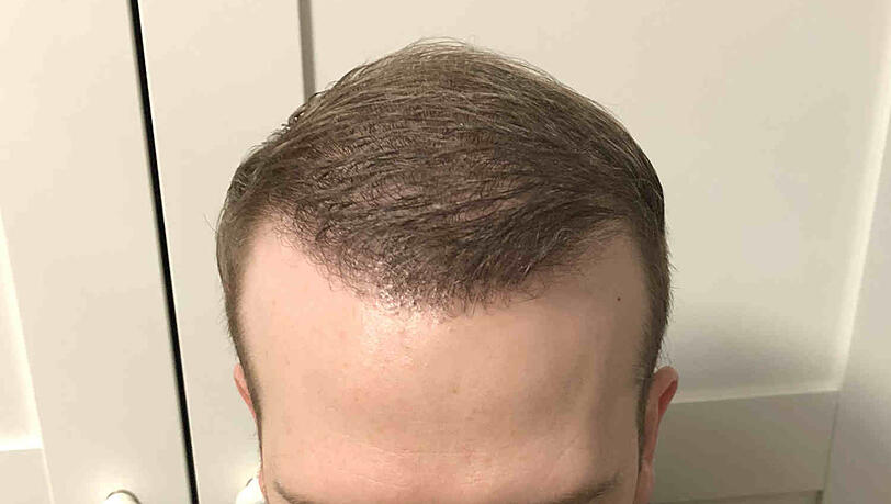 Sechs Monate nach der Haartransplantation. Sechs Monate nach der Haartransplantation.