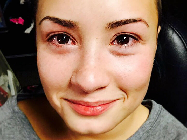 Demi Lovato leidet unter einer Katzenallergie