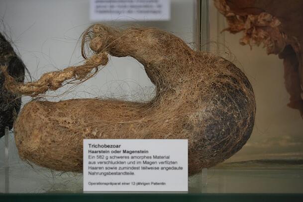 Dieses 582 Gramm schwere Haarknäuel wurde aus dem Bauch einer Zwölfjährigen entfernt. Dieses 582 Gramm schwere Haarknäuel wurde aus dem Bauch einer Zwölfjährigen entfernt.