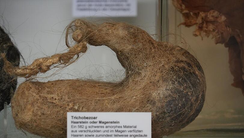 Dieses 582 Gramm schwere Haarknäuel wurde aus dem Bauch einer Zwölfjährigen entfernt. Dieses 582 Gramm schwere Haarknäuel wurde aus dem Bauch einer Zwölfjährigen entfernt.