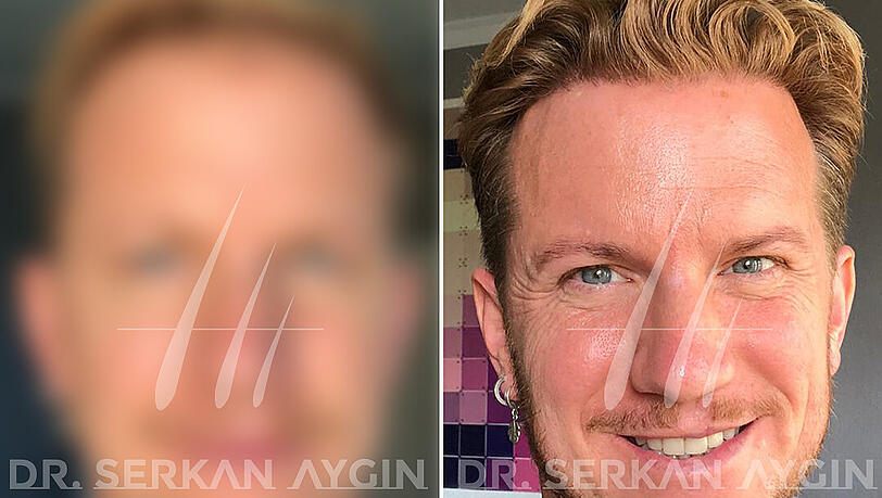 Eines von vielen erstaunlichen Vorher-Nachher-Ergebnissen der Dr. Serkan Aygin Clinic. Eines von vielen erstaunlichen Vorher-Nachher-Ergebnissen der Dr. Serkan Aygin Clinic.