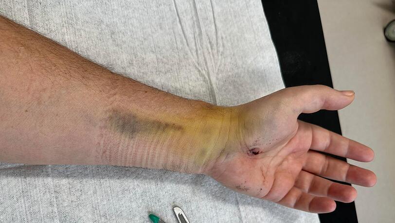 Bei dem Unfall hat sich Thomas Darchinger einen Knochen in der Hand dreifach gebrochen. Bei dem Unfall hat sich Thomas Darchinger einen Knochen in der Hand dreifach gebrochen.