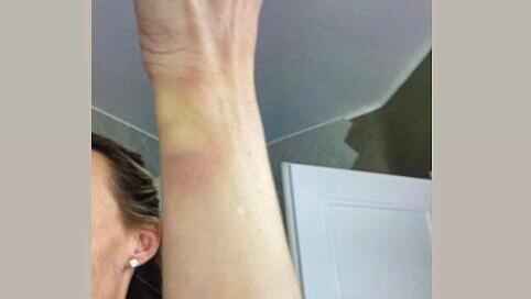 Cora Schumacher meldet sich via Instagram mit einem auffälligen Posting zurück. Zu sehen ist ein verletztes Handgelenk.