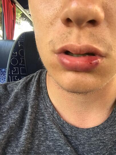 Brutalo-Attacke im Bierkönig am Ballermann. Erst feierte Christoph S., dann wurde er vom Türsteher brutal verprügelt.